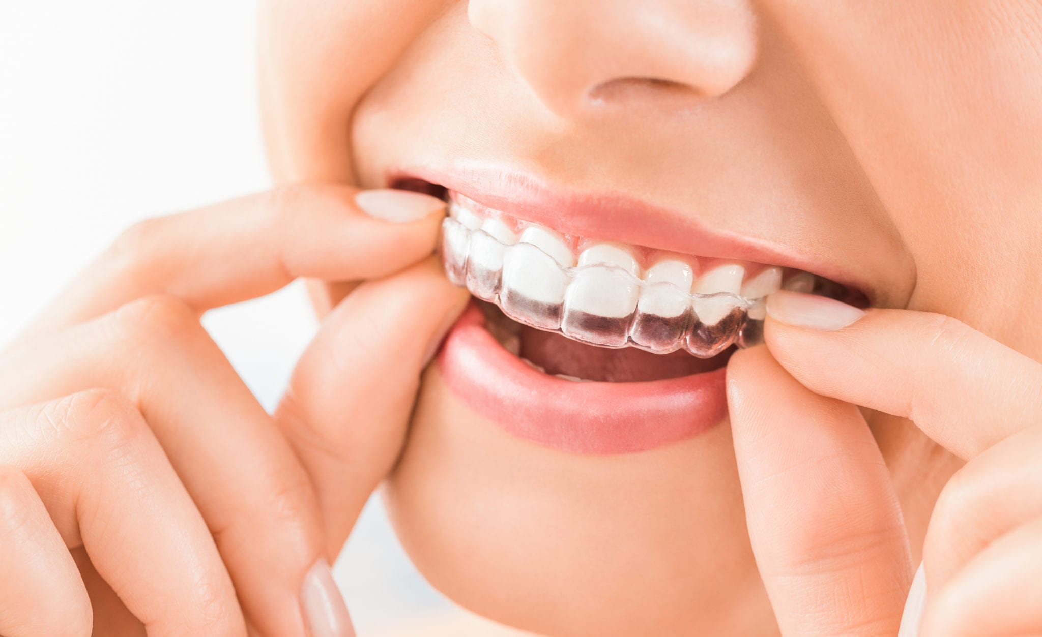 Invisalign Braces In Rocklin