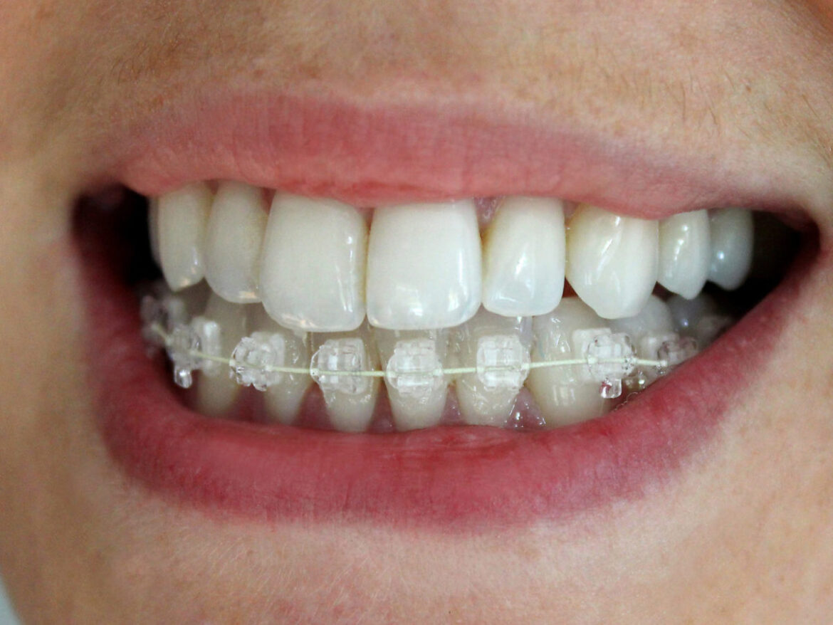 6 Month Braces Rocklin