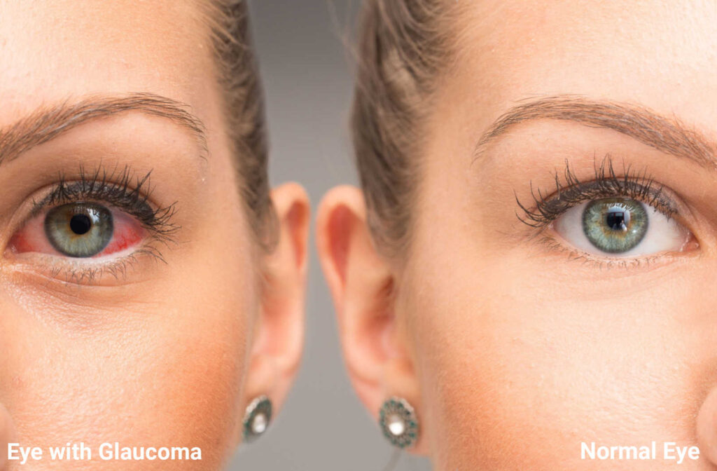 Glaucoma Symptoms and Treatment: What You Should Know