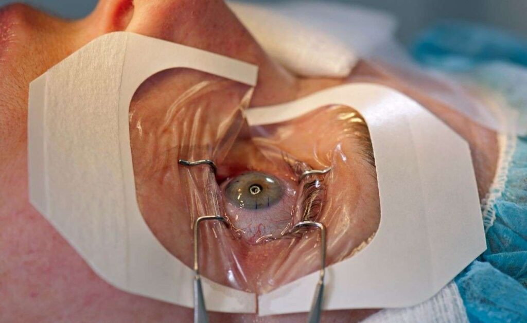 lasik surgery